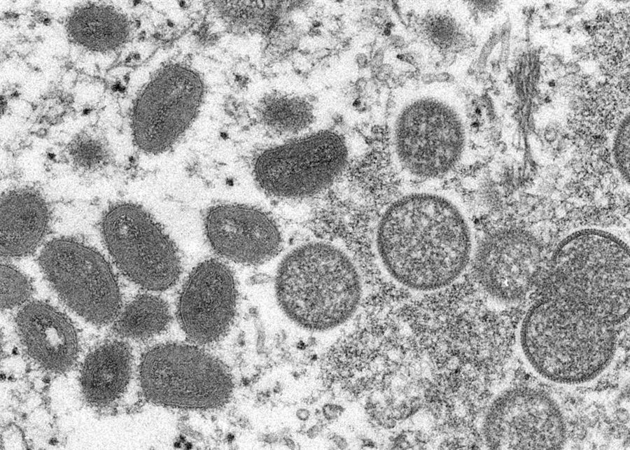 La Turquie enregistre le premier cas de variole du singe-ministre de la Santé